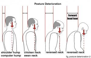 Good to Bad Posture Chart in Bellingham WA